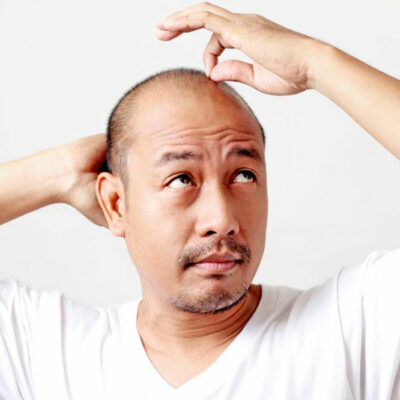 Prescription Treatments for Male Pattern Baldness