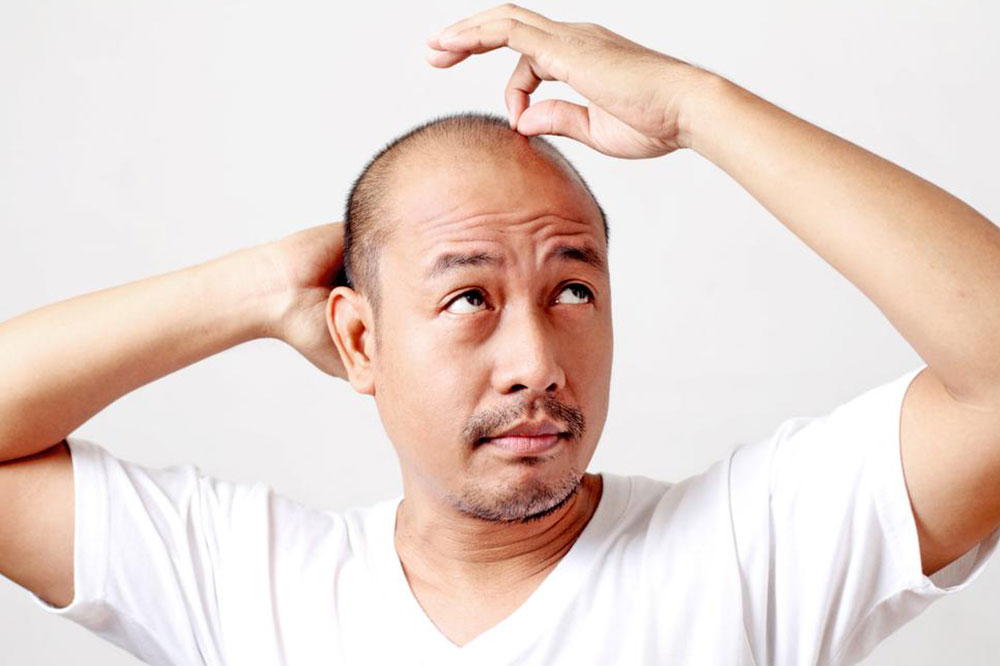 Prescription Treatments for Male Pattern Baldness
